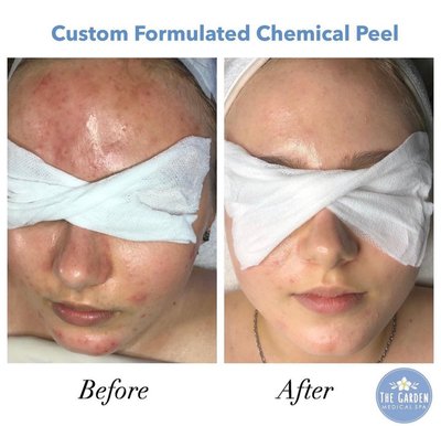 Chemical Peels  The Garden Medical Spa