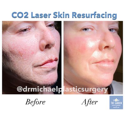 CO2 Laser Skin Resurfacing Near Tampa, FL