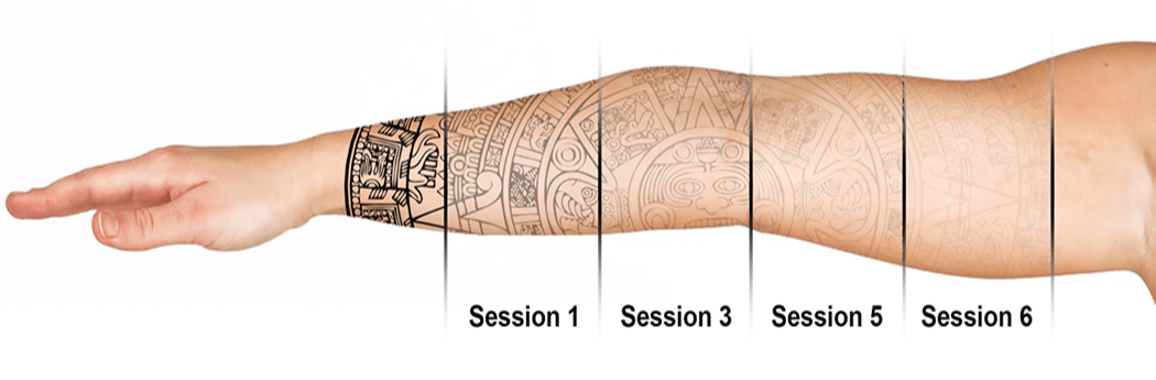 Why You Need Multiple Sessions To Remove a Tattoo  Saved Tattoo